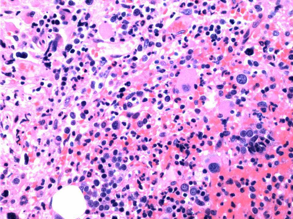 M:E ratio appears decreased due to decreased granulopoiesis and slightly increased erythropoiesis. Granulopoiesis demonstrates complete maturation. Erythropoiesis demonstrates complete normoblastic maturation.